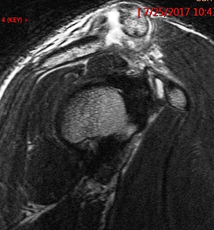 Figure 4 for case Grade 3 AC separation ( RID1895 )
